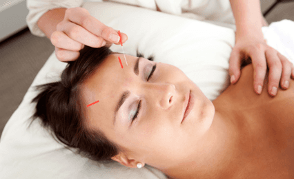 A lady having acupuncture in her forehead 