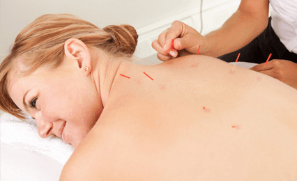 A lady having acupuncture 