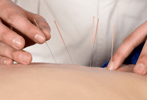 A close up of acupuncture needles