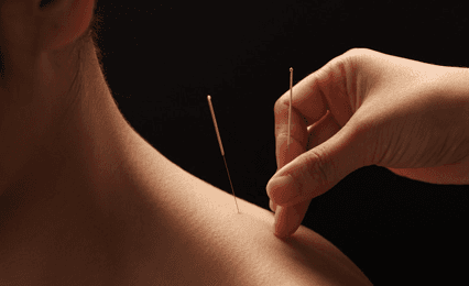 A close up of acupuncture needles going into a shoulder