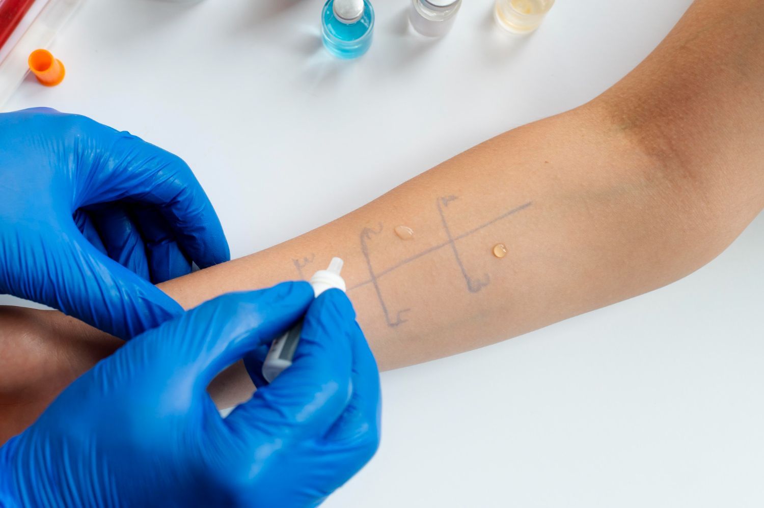 allergy skin test