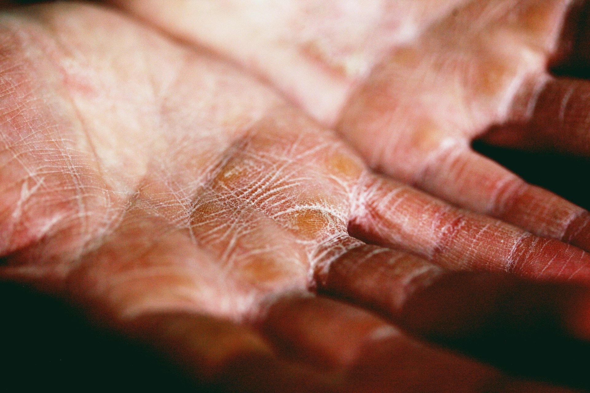 pruritus itchy skin on hands close up