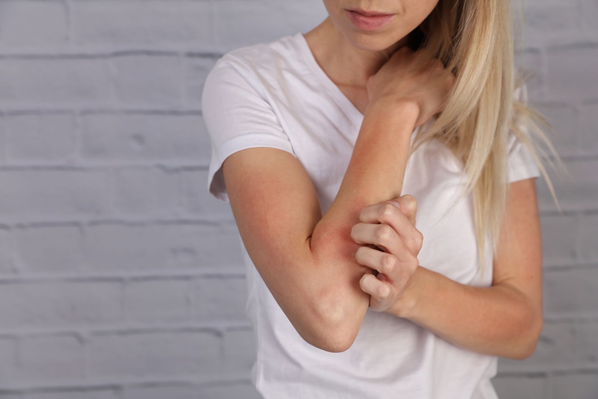 woman itching skin eczema on arm