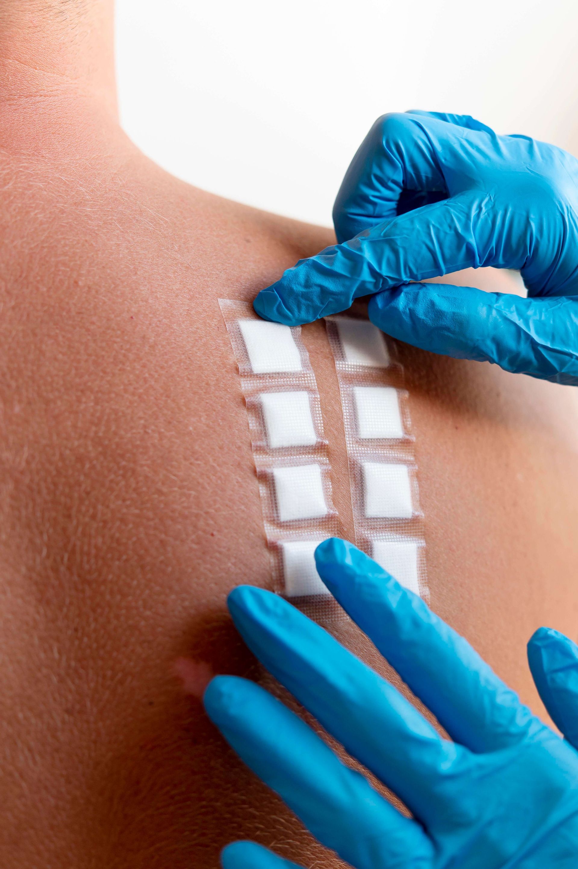skin patch testing for allergies