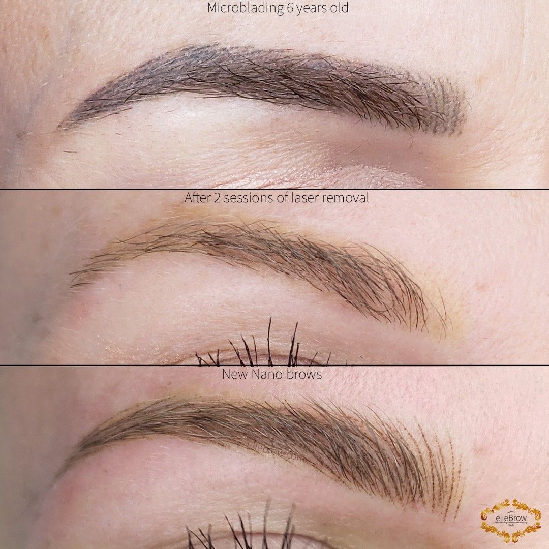 Microblading before laser, after laser, after new microblading (nano brows)