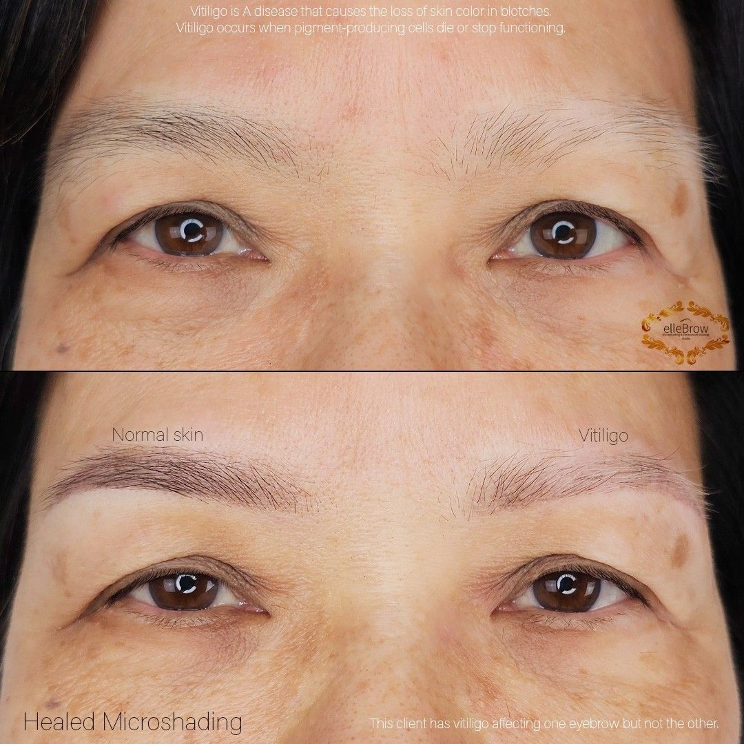 Microshading on Client with Vitiligo