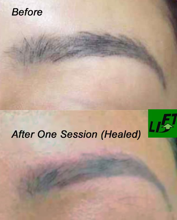 Tattoo Removal  Chasse Permanent Makeup