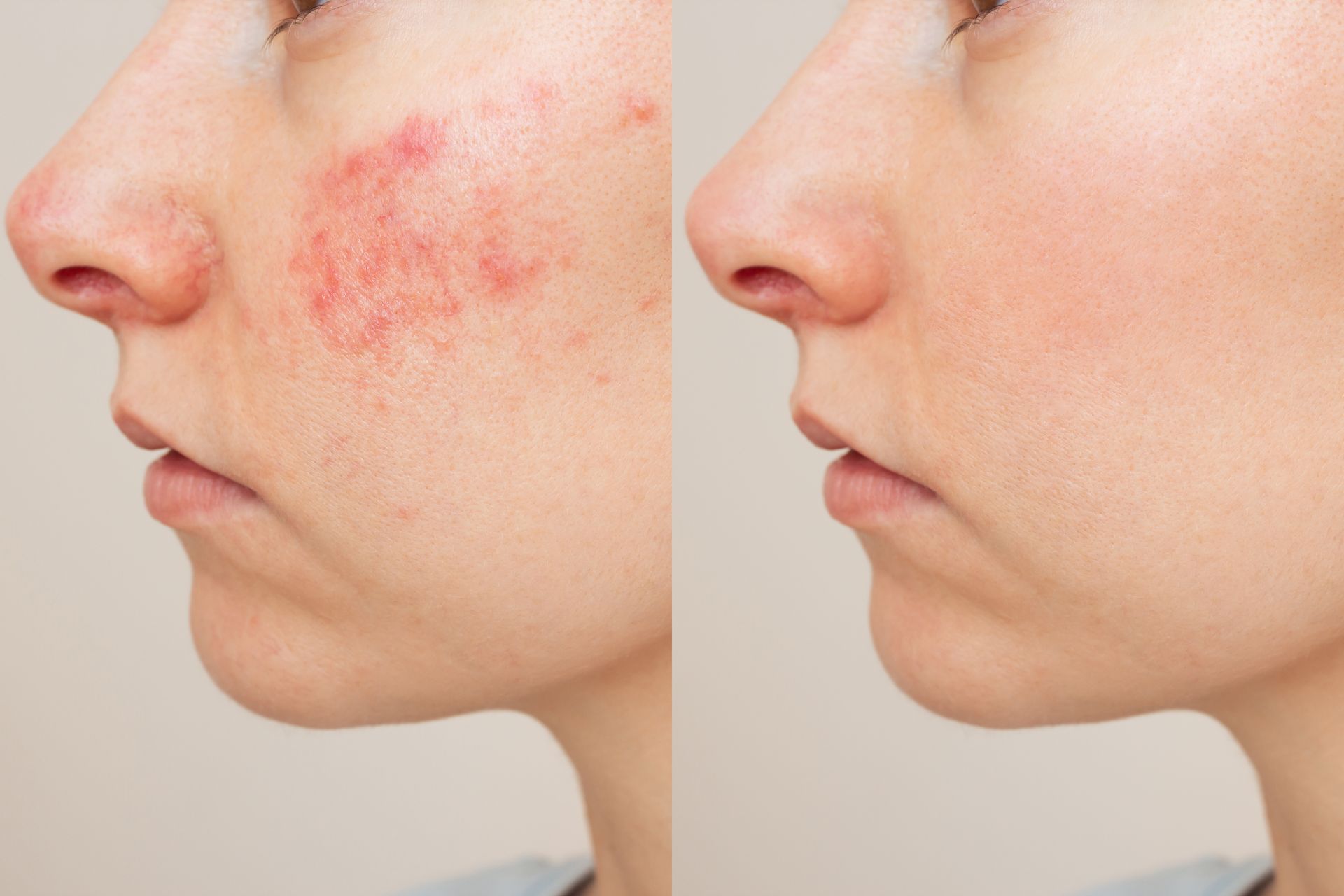 A before and after photo of a woman 's face with acne.