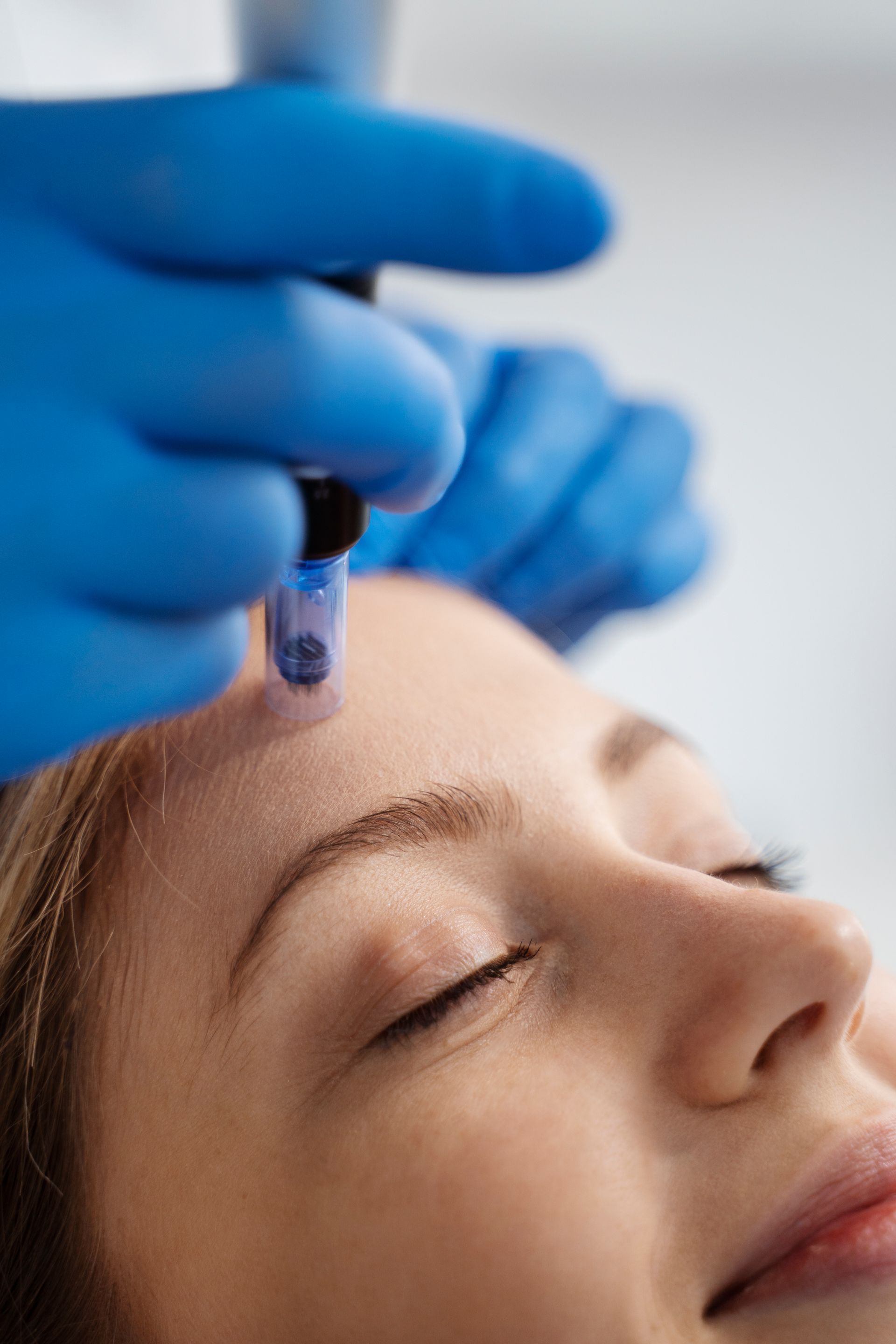 Person receiving microneedling treatment on their forehead. Blue-gloved hand uses a device with tiny needles.