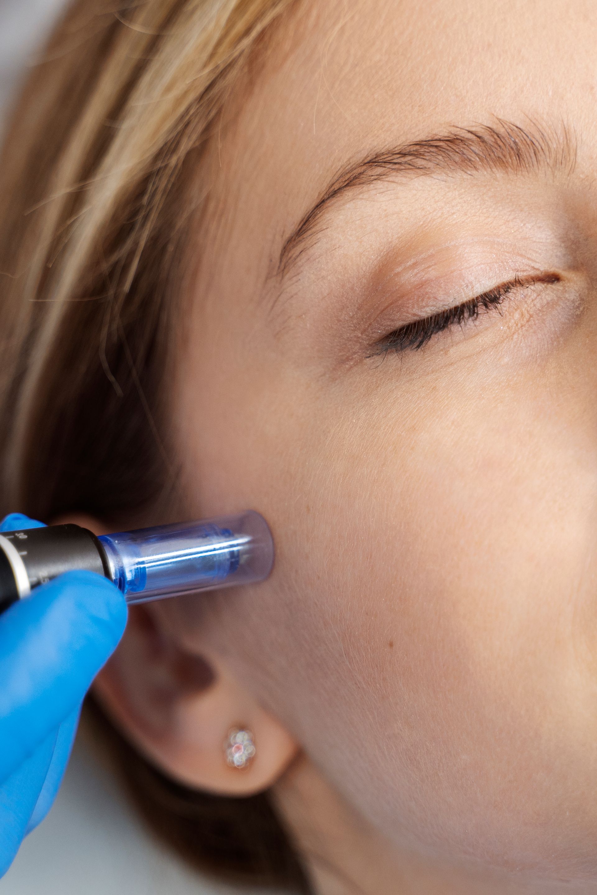 A woman is getting a microneedle treatment on her face.