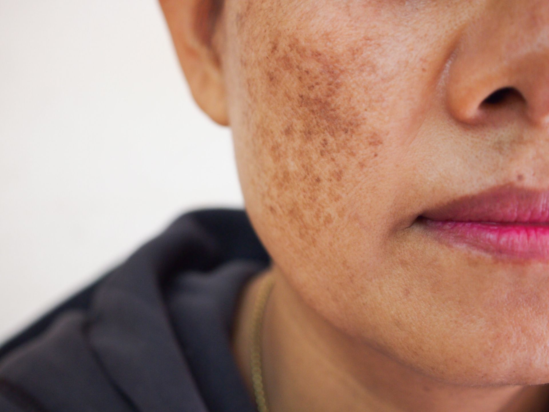Close-up of a person's face showing skin with uneven brown patches, likely hyperpigmentation, on the cheek.