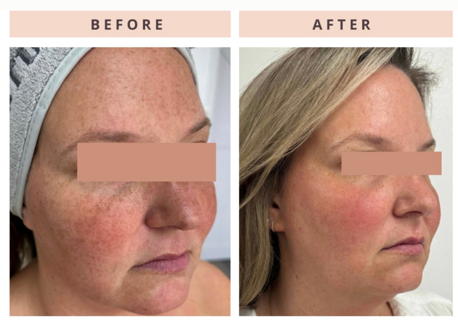 Microneedling in Michigan