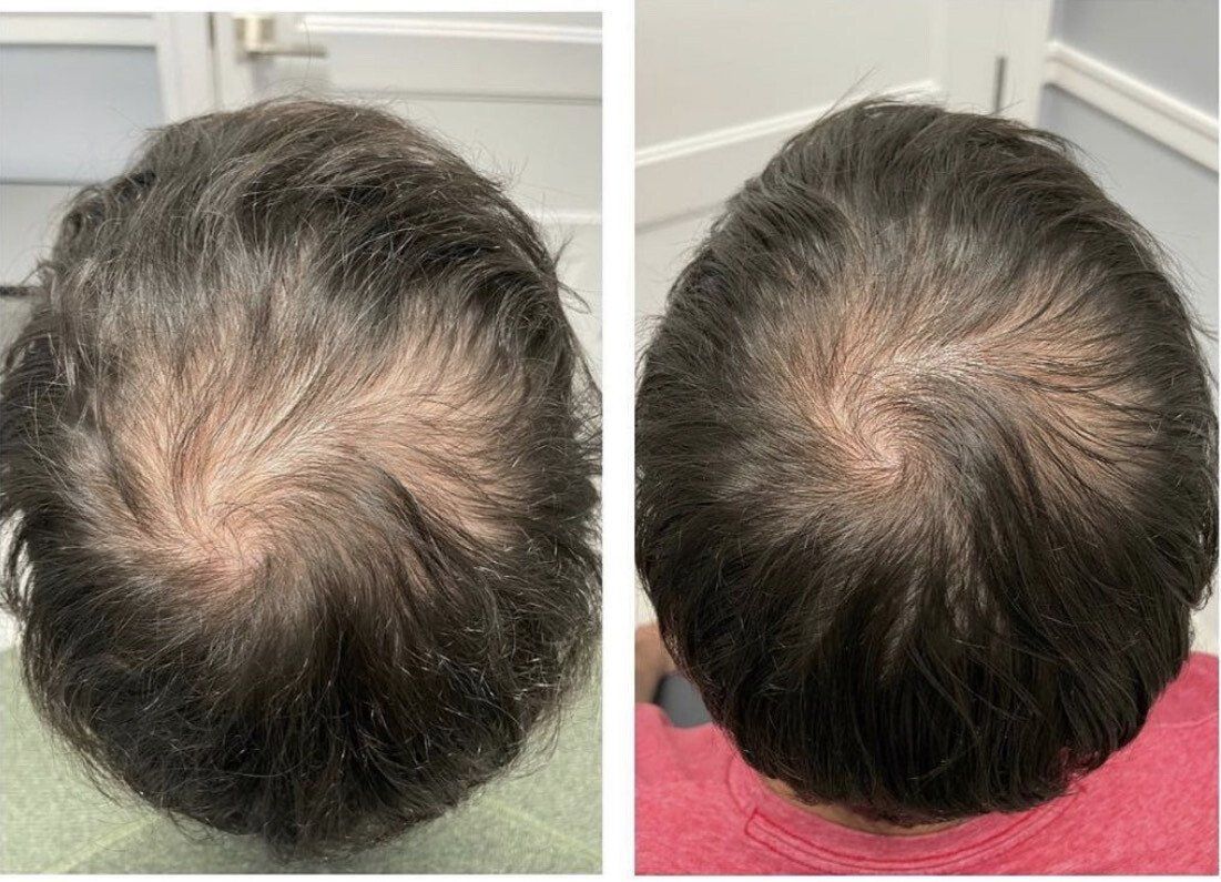Hair transplant michigan