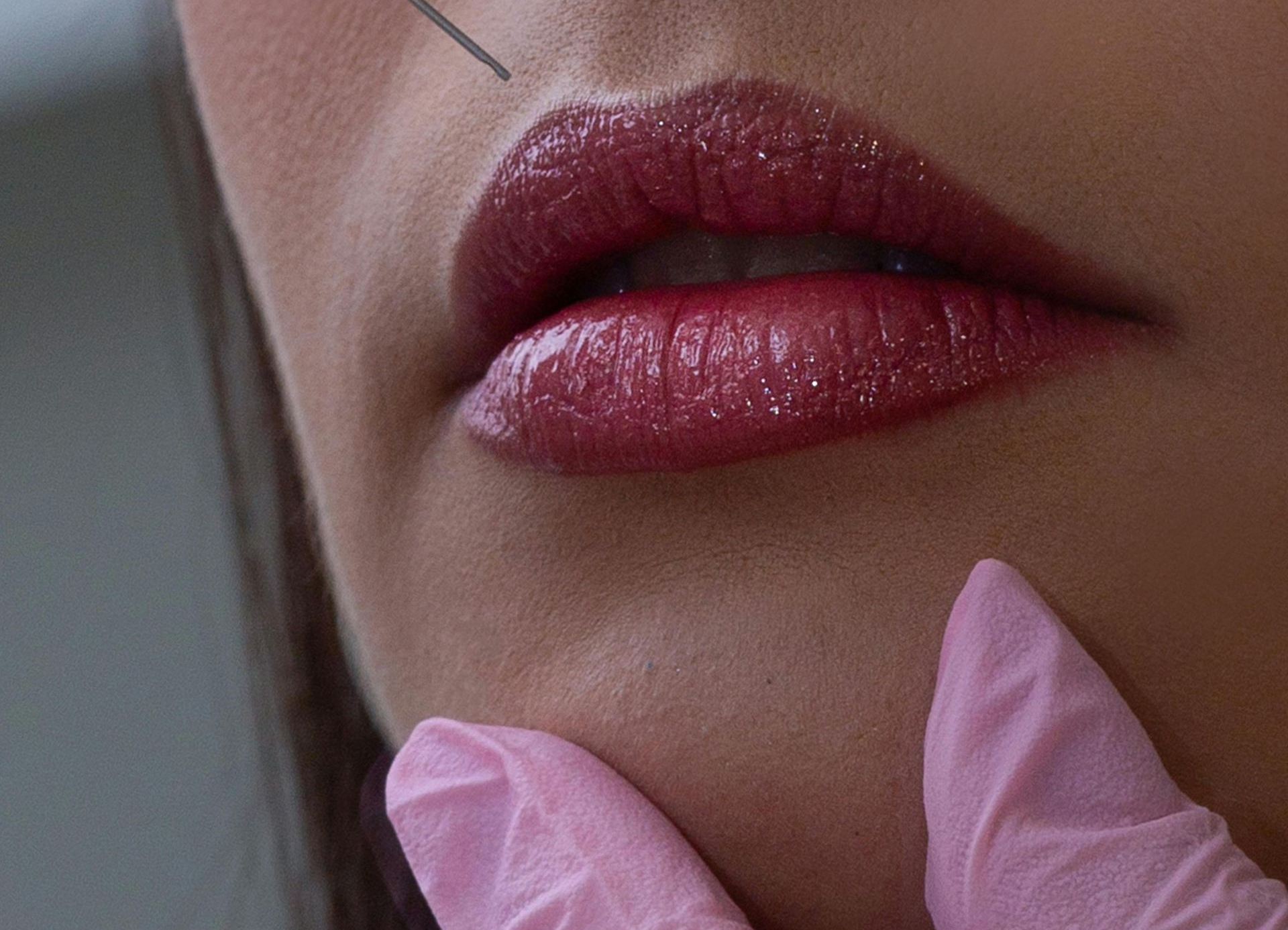 Botox at SkinMD Michigan