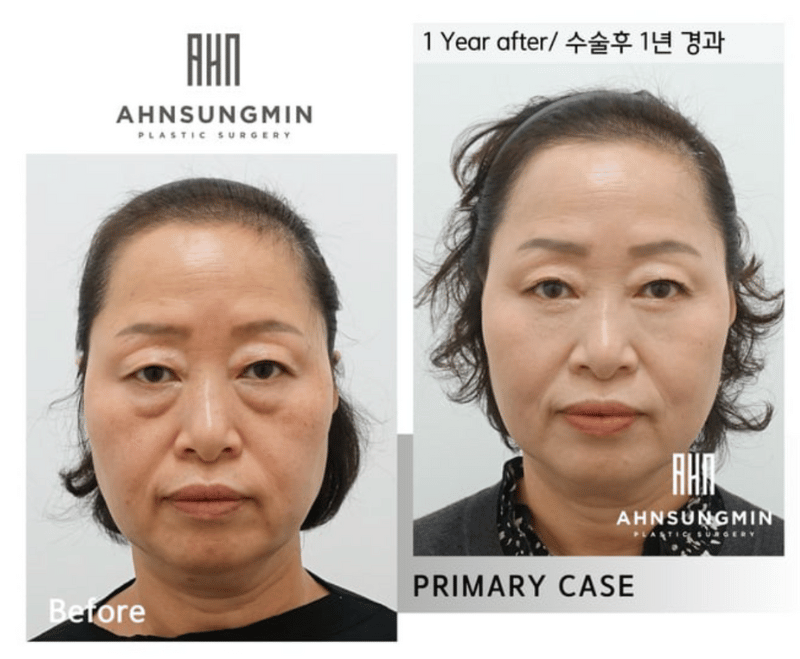 Under-eye fat relocation, mid-face lift