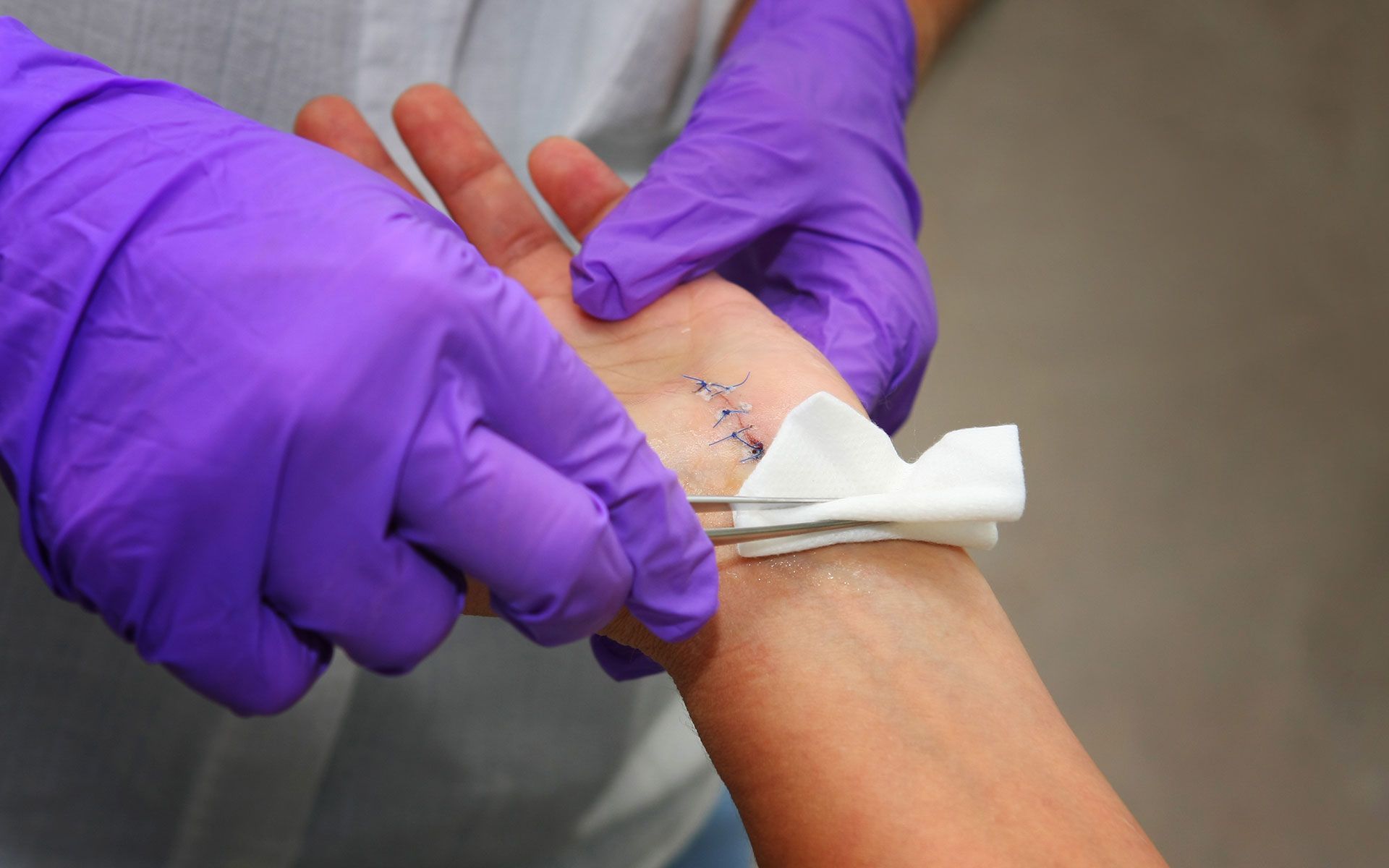 A medical professional in purple gloves cleans a stitched wound on a patient's wrist with a cotton pad.