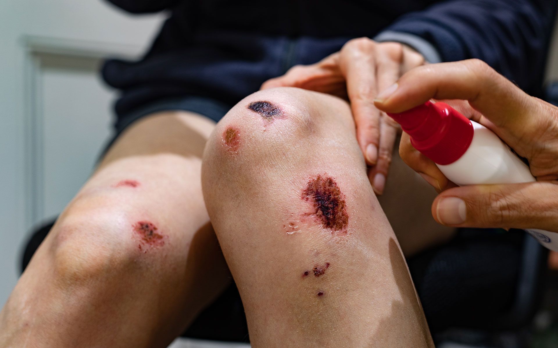 Person spraying antiseptic on scraped knees.
