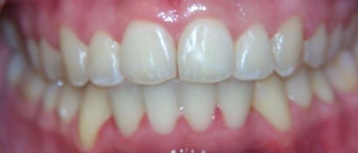 A close up of a person 's teeth with white teeth