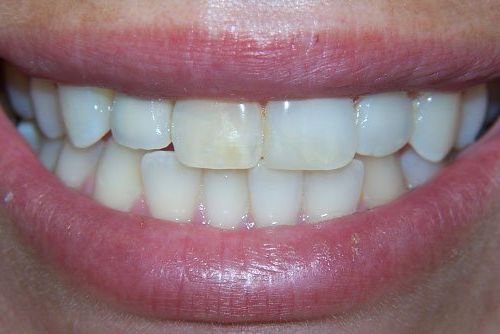 A close up of a woman 's smile with white teeth.