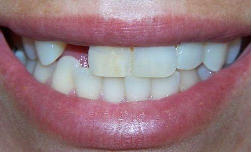 A close up of a person 's mouth with a missing tooth.