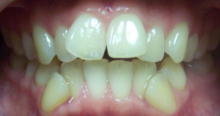 A close up of a person 's teeth with a few missing