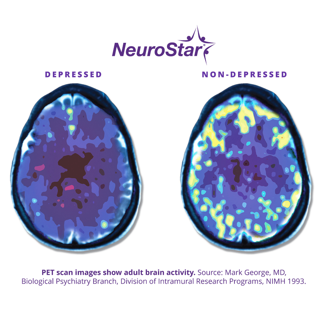 Is NeuroStar TMS Effective? An Explanation For Those With Treatment ...
