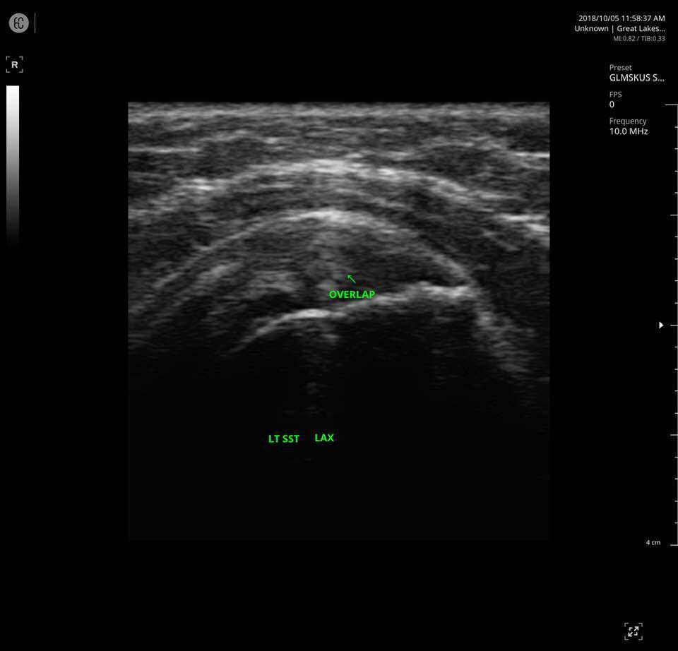 Overlap in X-Ray Result
