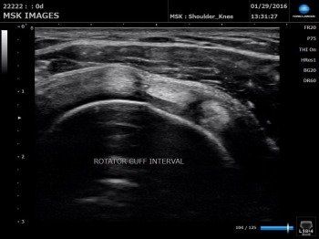 Rotator Buff Interval in Ultrasound
