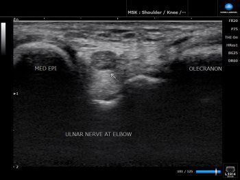 Ultrasound Result