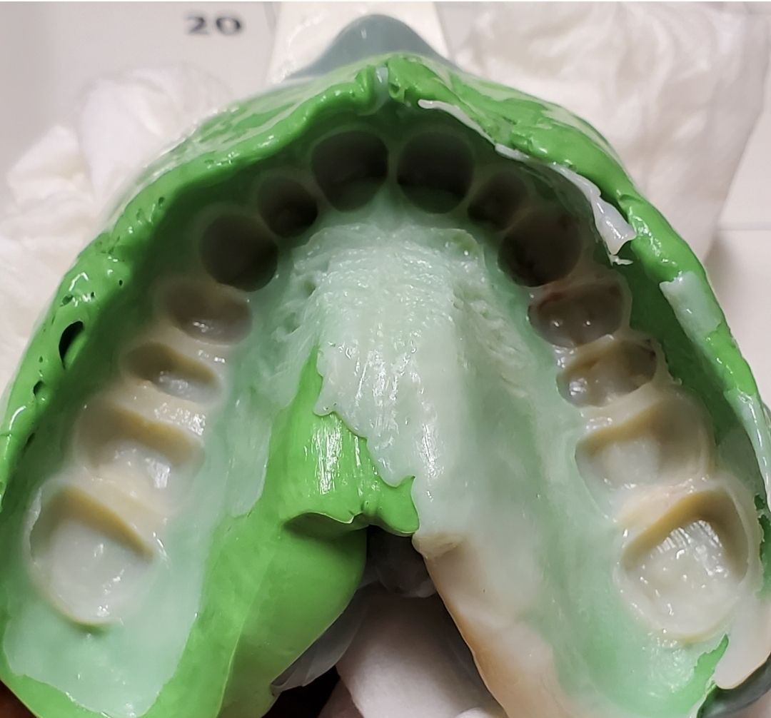 Full mouth reconstruction dentist in Tarzana, Implant dentist, cosmetic dentist, 