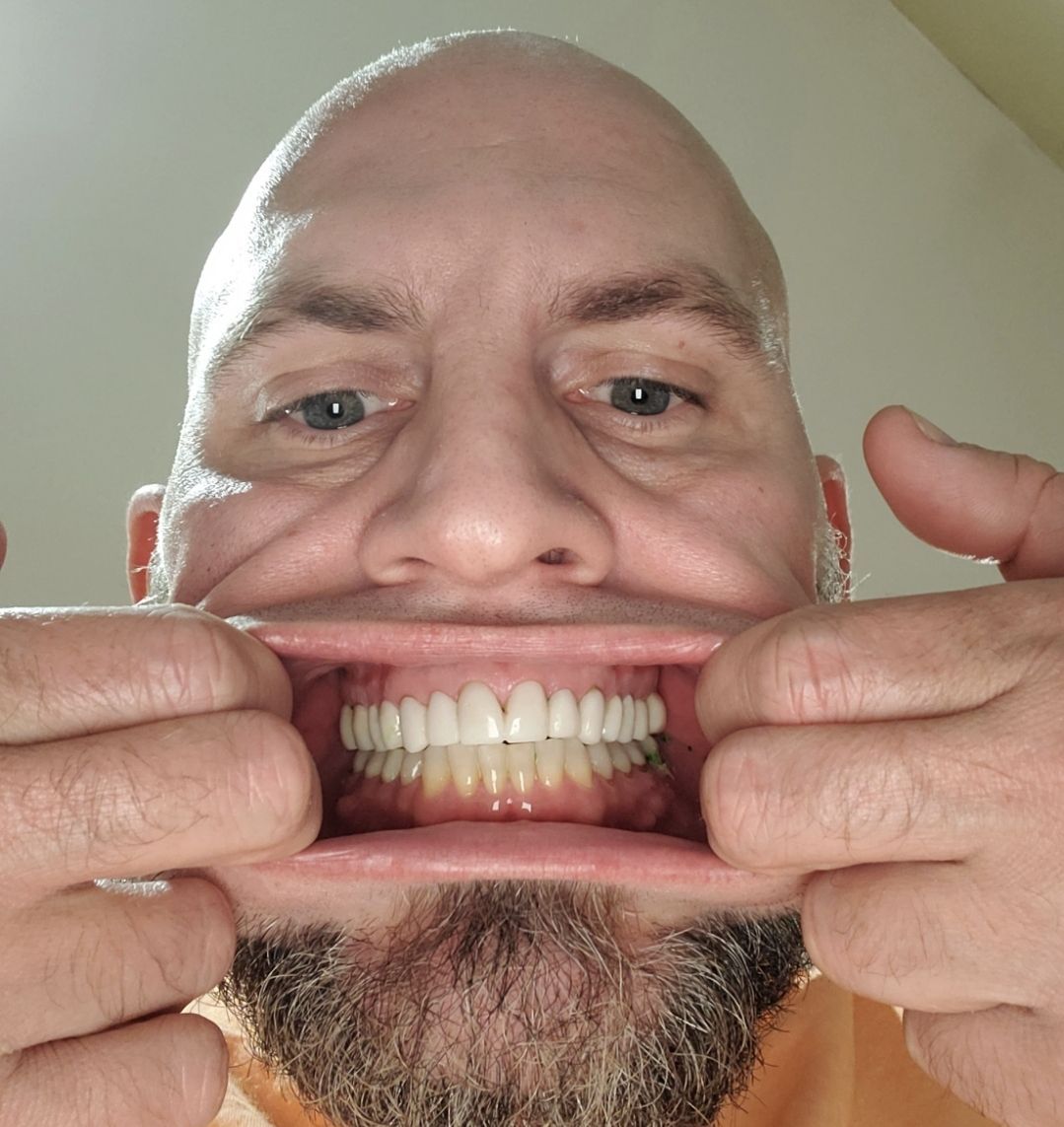 Cosmetic dentist in Tarzana, Full mouth reconstruction in Tarzana, emergency dentist in Tarzana