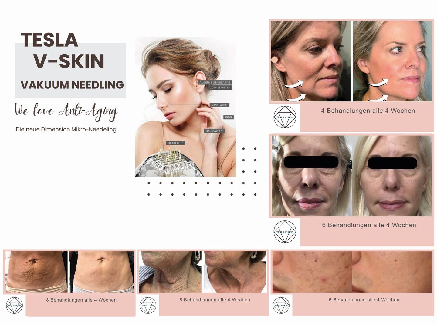 Das Gesicht einer Frau wird vor und nach einer Tesla V-Skin-Vakuum-Needling-Behandlung gezeigt.