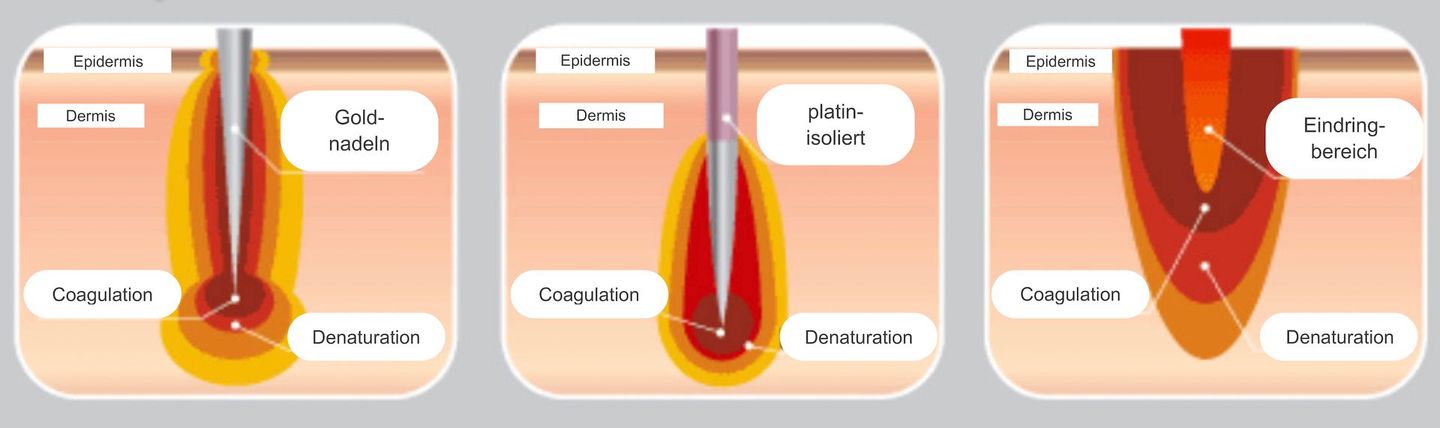 Ein Diagramm, das den Vorgang der Laser-Haarentfernung zeigt.