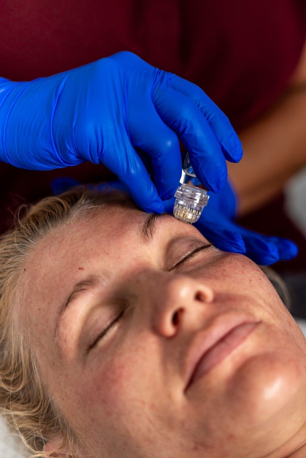 Person receiving a facial treatment; gloved hand using a microneedling device on their forehead.