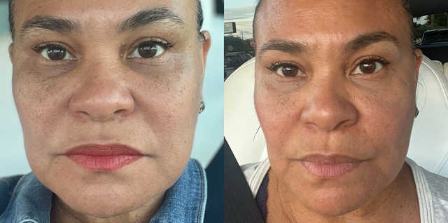 best treatments for skin laxity post-tirzepatide busy moms PRX Treatments | Plantation, FL