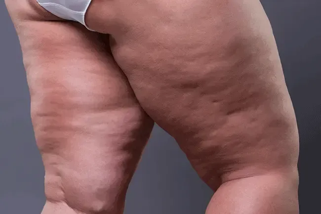 A woman in white underwear has a lot of cellulite on her legs.