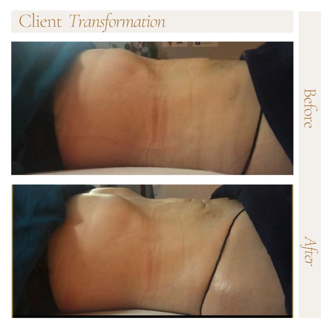 A before and after picture of a woman 's stomach