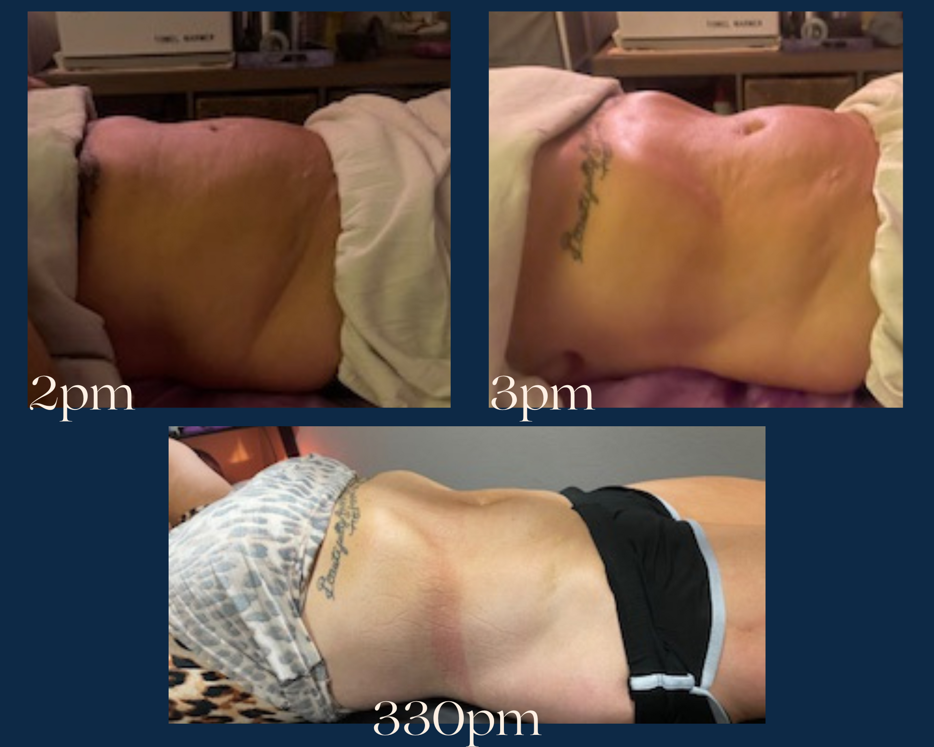 A before and after photo of a woman 's stomach