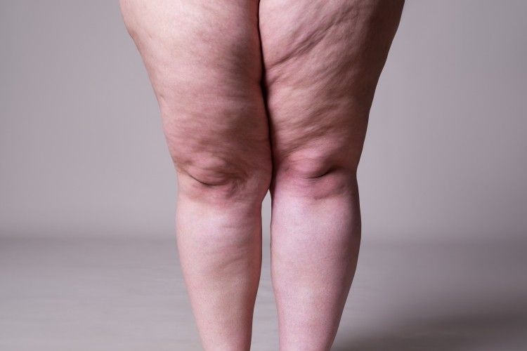 A woman 's legs are shown with a lot of cellulite on them.