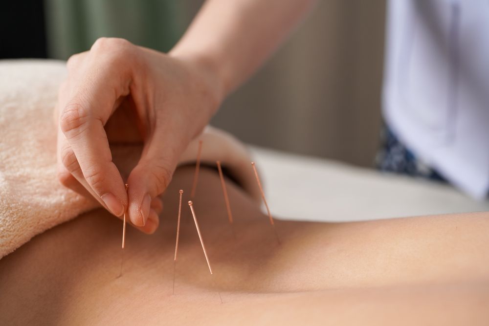 Acupuncture being used to treat pinched nerves.