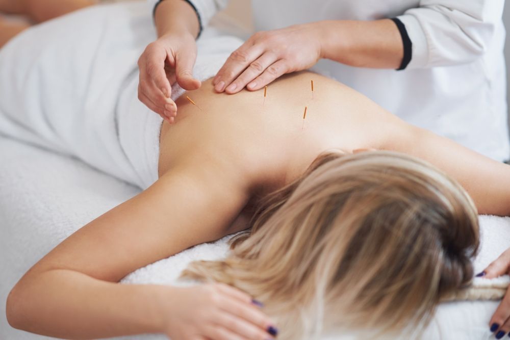 A woman is getting an acupuncture treatment on her back.