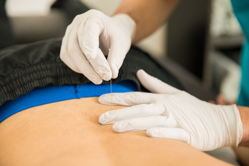 a person is getting an acupuncture treatment on their back