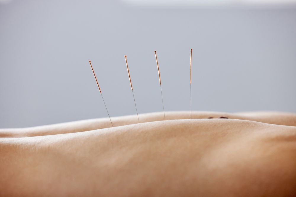 A person is getting acupuncture on their back.