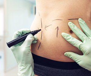 Plastic Surgery Orlando — Doctor Putting Guide Marks in Orlando, FL Plastic Surgery Orlando — Doctor Putting Guide Marks in Orlando, FL