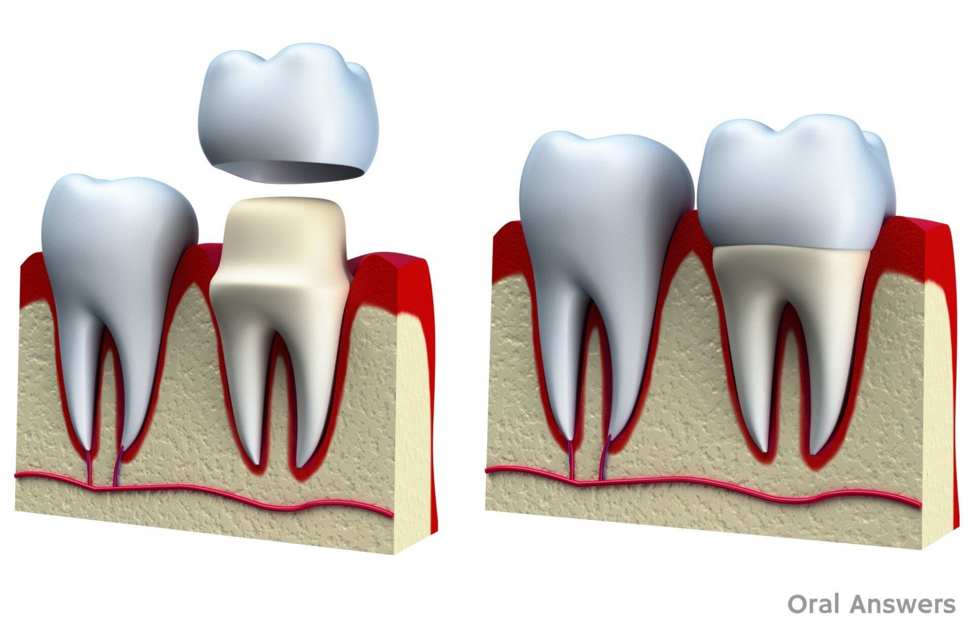 What’s the Difference Between Dental Crowns and Sealants?
