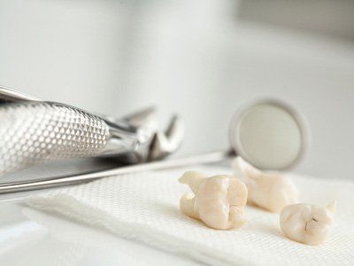 3 Reasons Why Teeth Get Extracted