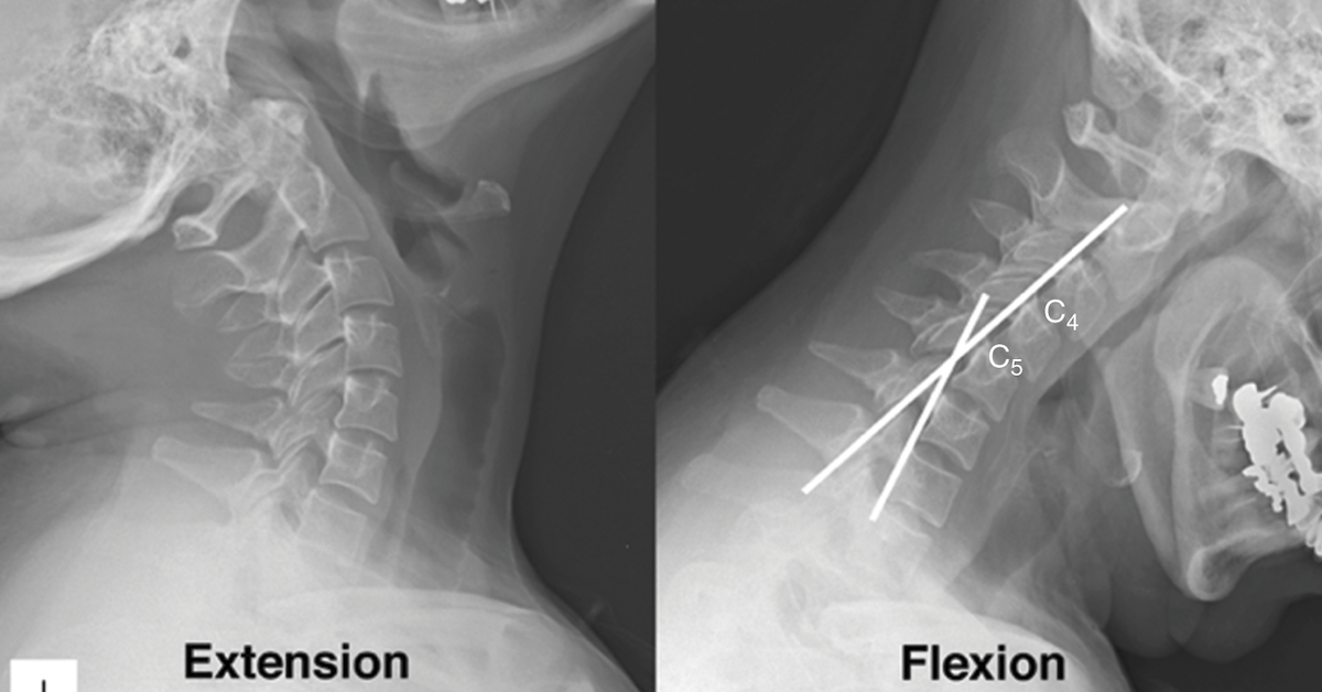 What Makes Upright MRI the Best Choice for Flexion and Extension Imaging?