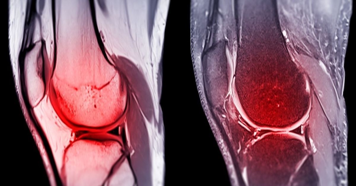 What Should I Know About MRI Knee Scans?