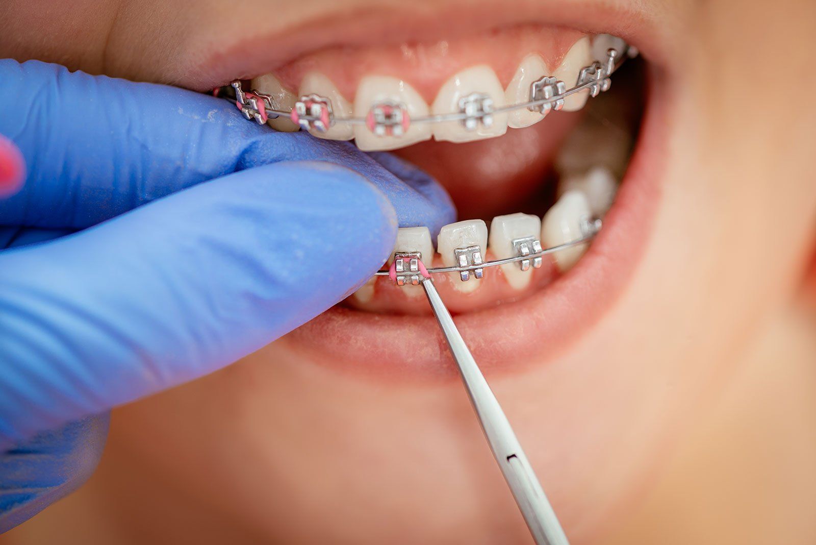 applicazione apparecchio ortodontico