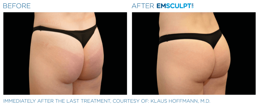 EMSculpt Neo Results for glutes